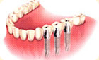 インプラントが支持する人工歯