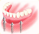 ①インプラント支持の取り外し式総入れ歯