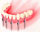 インプラント支持の固定式義歯(ブリッジ)